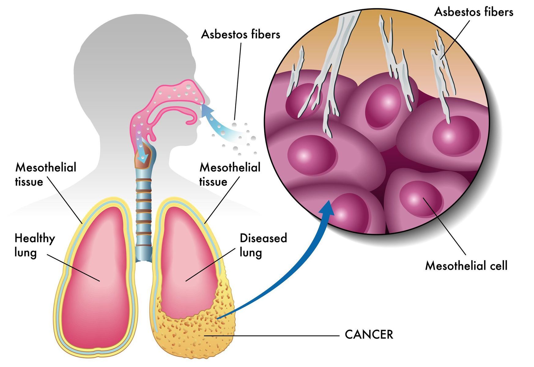 mesothelioma caused by asbestosis