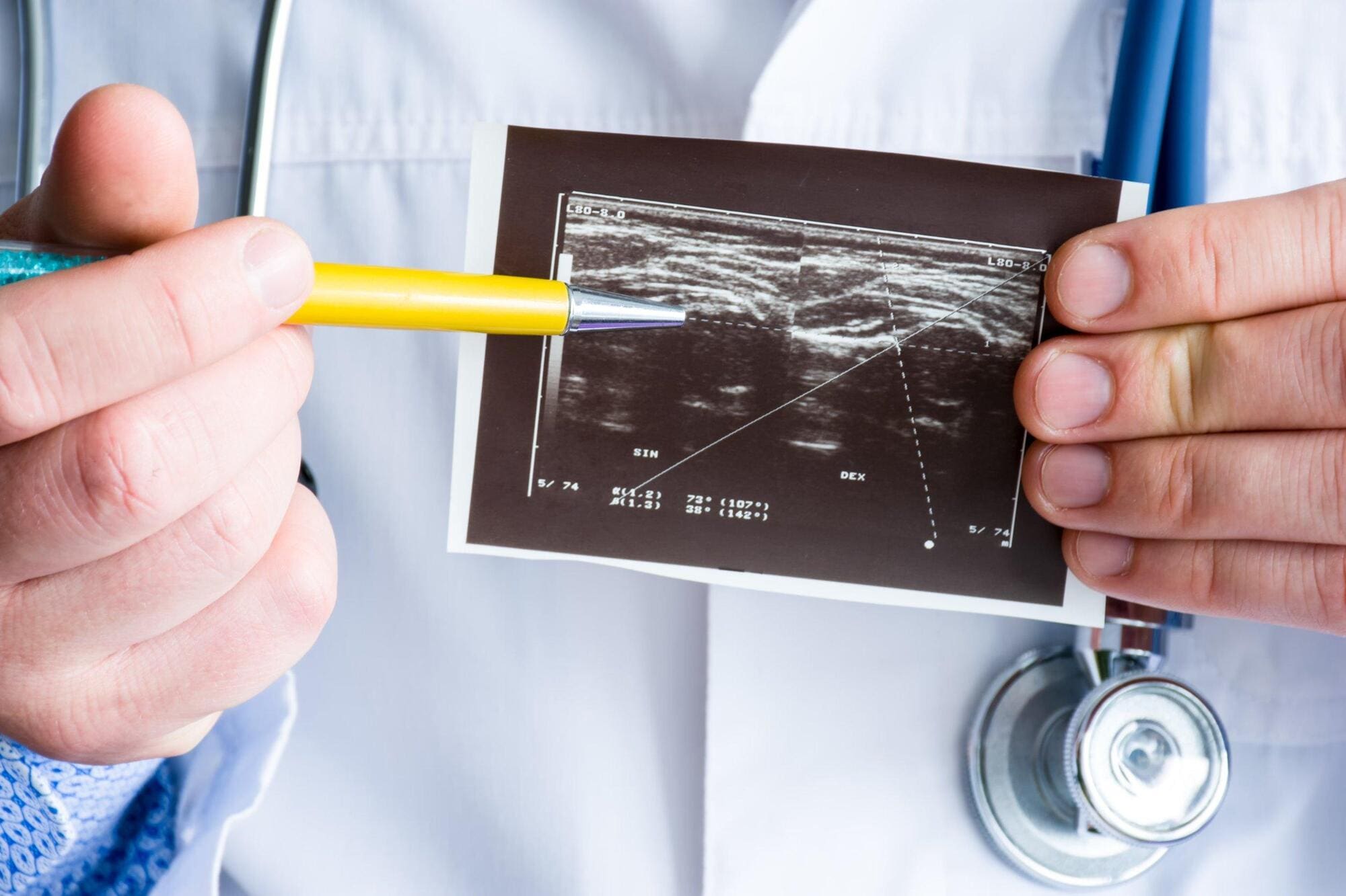 Genetic condition of dwarfism shown on a baby scan Genetic condition of dwarfism shown on a baby scan