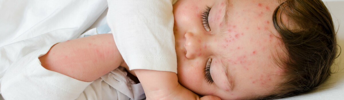 Baby with Chickenpox