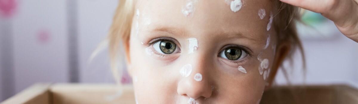 Baby with chickenpox having treatment