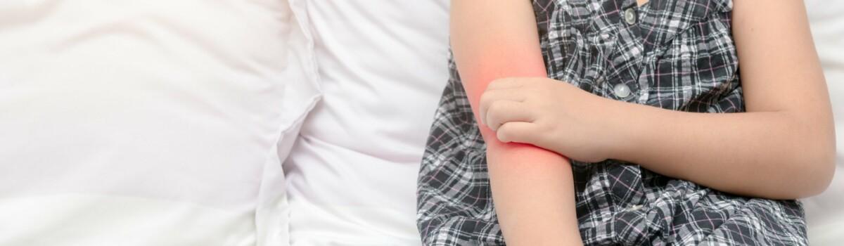 Child with food allergens makes eczema worse