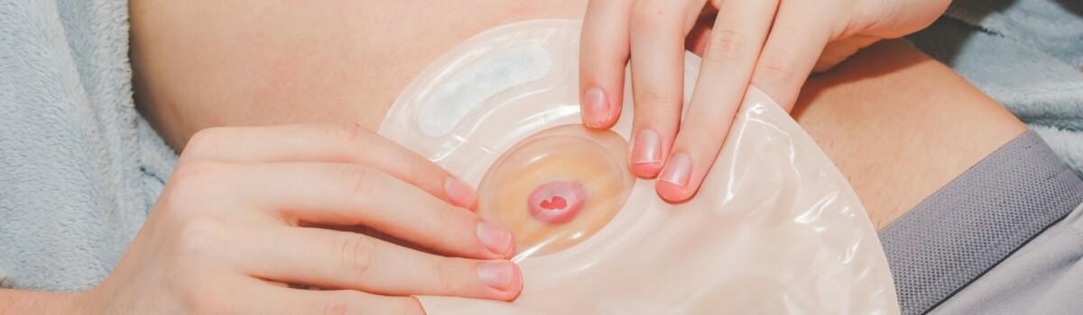 Stoma Care