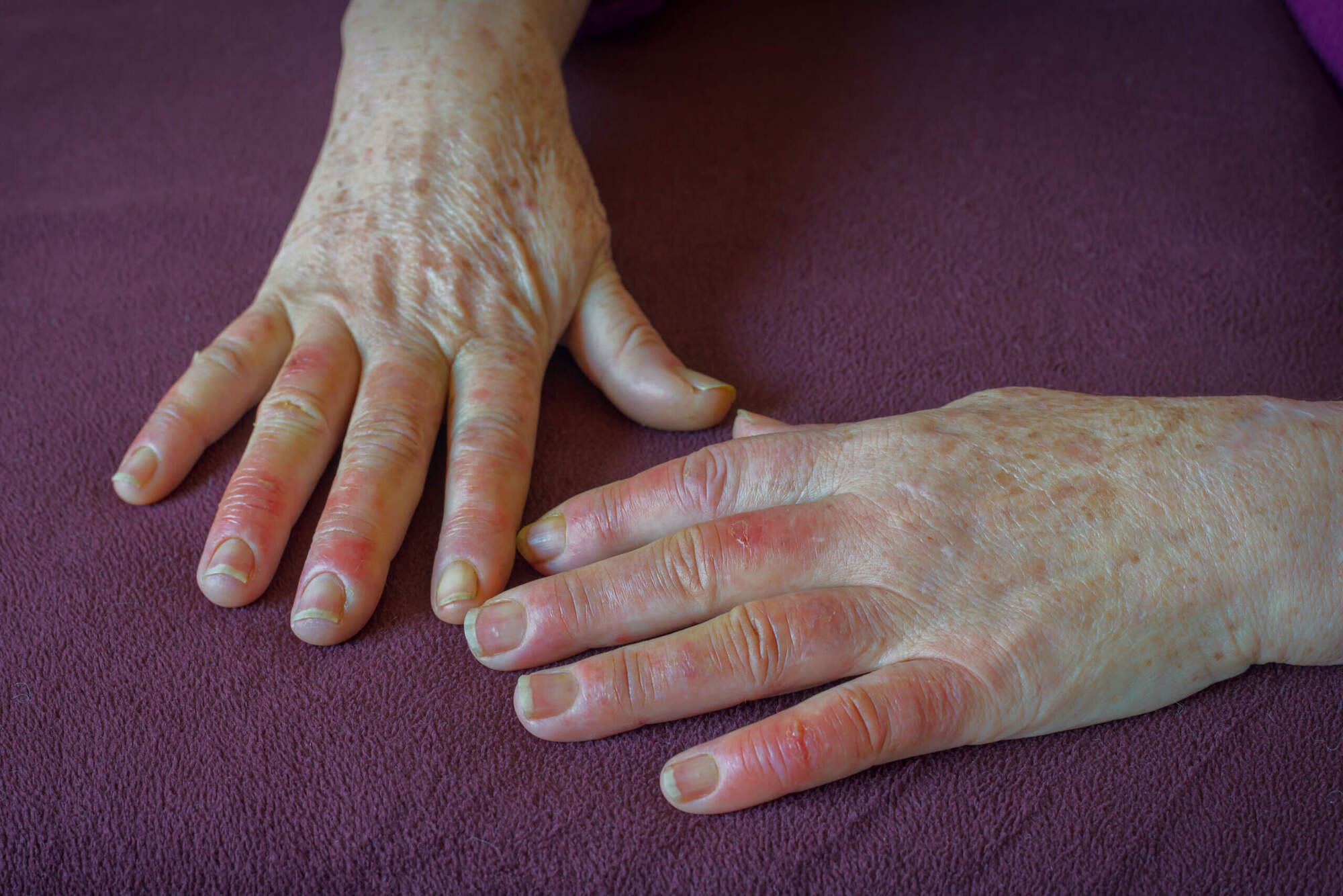 HAVS Risk Assessments 2 Raynauds